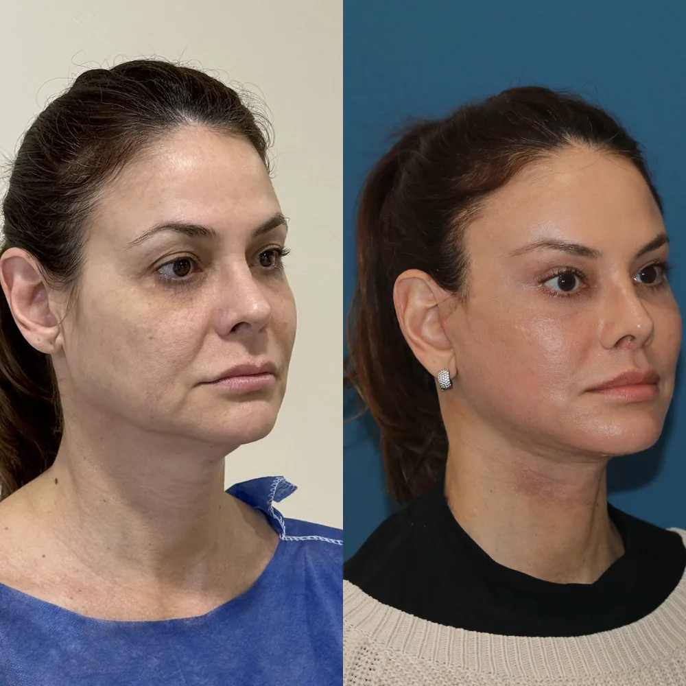 Antes e depois de lifting facial endoscópico — paciente do Dr. Laertes